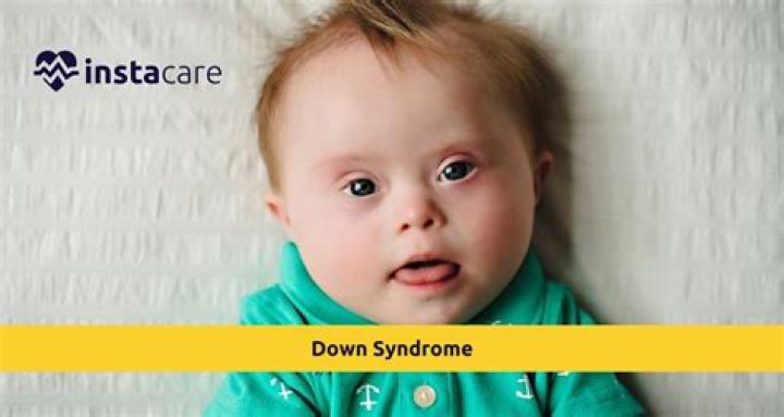 Is George Clooney's Son Affected By Down Syndrome? Unraveling The Truth